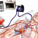 ECMO là gì, khi nào bệnh nhân cần can thiệp ECMO?
