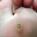 MỘT SỐ U LÀNH TÍNH Ở DA