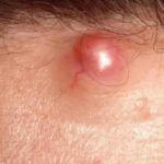 U nang bã nhờn là gì? – Những thông tin bạn cần biết