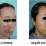 U máu – Bệnh viện da liễu trung ương